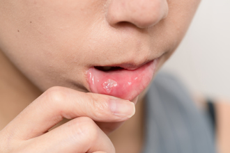 嘴破吃4類食物加速癒合 專家：用鹽水漱口是大忌