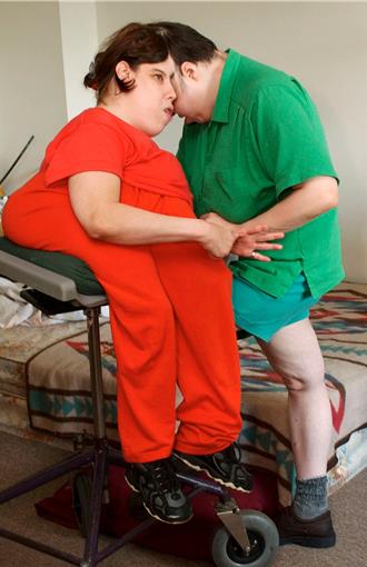 世界上最年长连体双胞胎去世 享年62岁