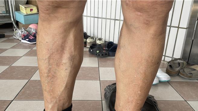 患有静脉曲张民眾不仅下肢会布满宛如蚯蚓般的血管，更有酸痛肿胀等症状。（亚大医院提供／冯惠宜台中传真）