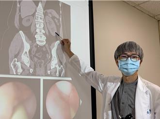 女健檢意外發現「3顆腎」功能更好？醫提醒1事