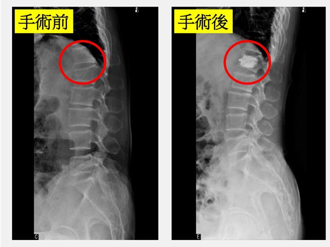 89歲莊老太太身體硬朗，不料日前在家打掃彎腰突然聽到「啪」一聲伴隨劇痛，休息3周無改善，就醫發現第1節腰椎「骨質疏鬆性壓迫性骨折」，幸採微創低溫骨水泥灌注椎體成型手術大幅改善。（大里仁愛醫院提供／潘虹恩台中傳真）