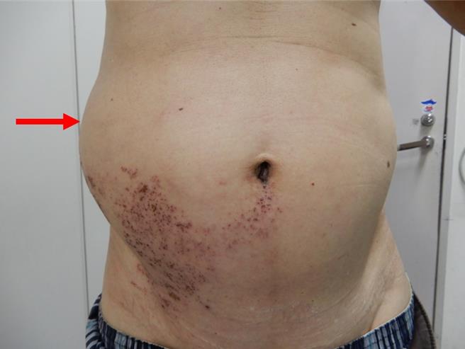 54歲男子罹患帶狀疱疹，突然右側腰部鼓凸一大塊。（澄清醫院提供／馮惠宜台中傳真）