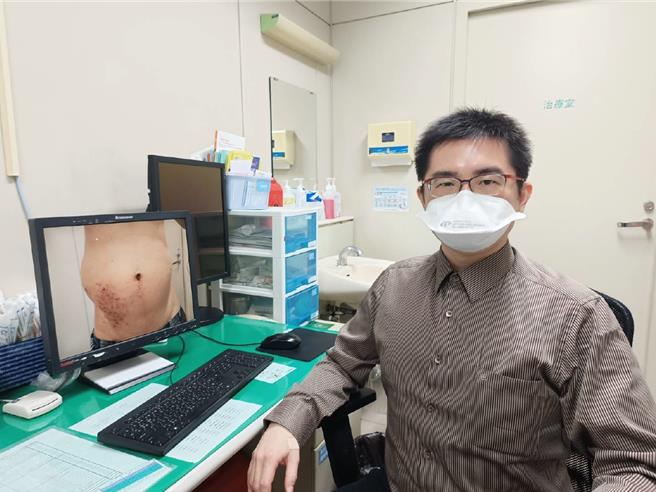 澄清醫院中港院區皮膚科主任柯偉立表示，該名54歲男子因罹患帶狀疱疹，突然右側腰部鼓凸一大塊，趕忙來就醫。（澄清醫院提供／馮惠宜台中傳真）