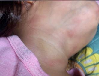 台东2岁女童「颈部瘀伤」疑遭掐颈　幼儿园：同学间抢玩具