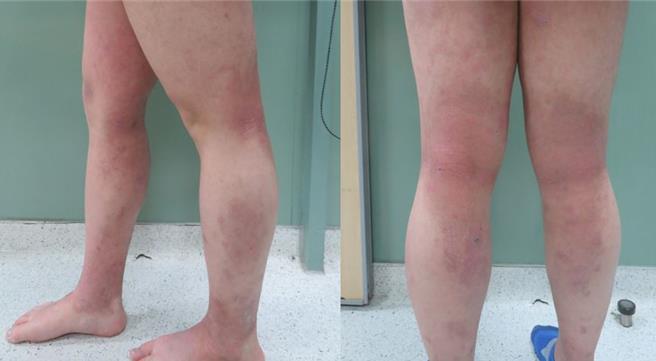 在配合新竹馬偕皮膚科謝雅如主任的治療計畫，鄭姓同學接受半年的治療後，皮膚情況大幅好轉。（新竹馬偕醫院提供／王惠慧新竹傳真）