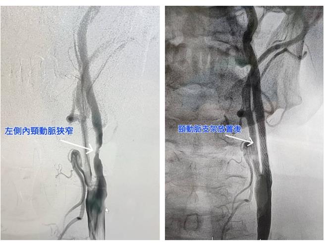 頸動脈支架置放術可將狹窄的頸動脈撐開，解決潛在的中風危機。（大千醫院提供／謝明俊苗栗傳真）