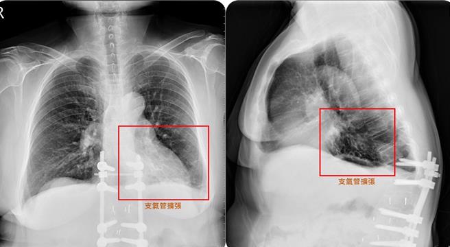  58岁简女士数月前却突然久咳不停，痰液浓稠偏黄且带有血丝，近日变本加厉且合併发烧、影响食欲，就医发现是支气管扩张症惹祸，经药物及呼吸復健1个多月大幅改善。（亚大医院提供／潘虹恩台中传真）