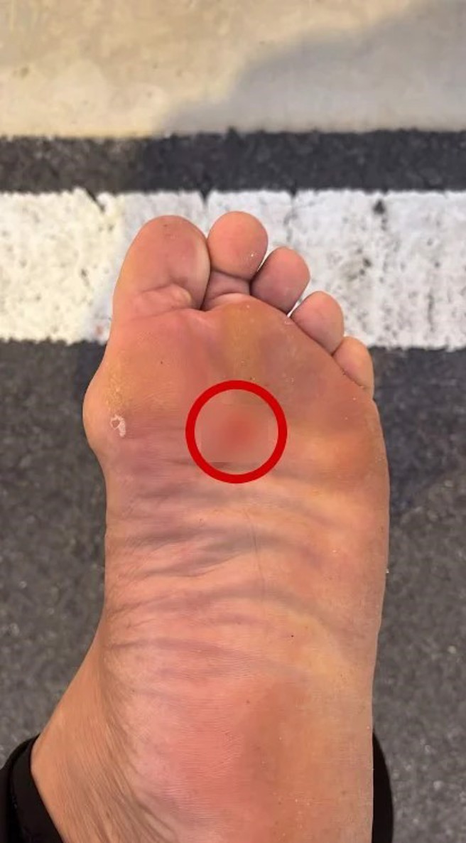 男子在慢跑途中遭鐵釘刺傷。（圖/翻攝中國報）