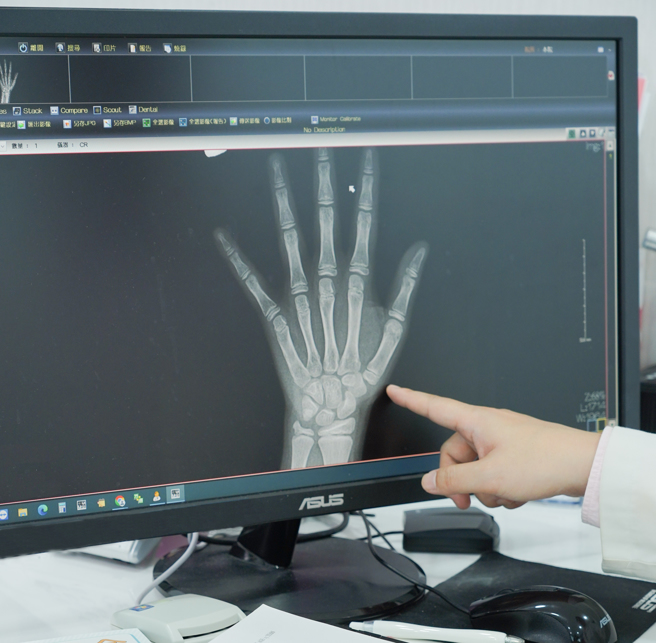 手部Ｘ光可以看到手指、手掌、手腕的生长板，需持续追踪半年至一年以上的时间，观察骨骼及生长板的变化，才得以让儿童内分泌专科医师较正确的推估骨龄、进一步作为性早熟病程的完整评估或后续治疗方针。(图/禾馨提供)