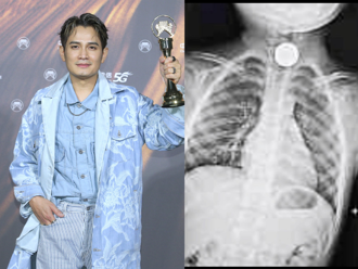 金曲歌王4歲兒「午睡誤吞硬幣」 煎熬8小時才取出