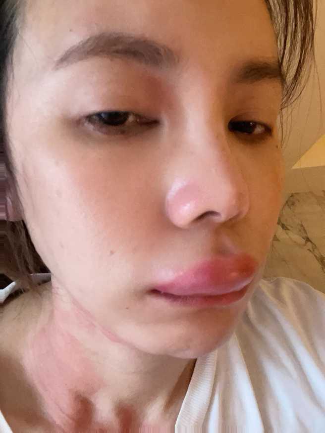 王偊菁的嘴唇肿胀。（图／王偊菁脸书）