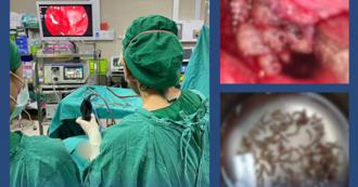 鼻血流不停 医生检查吓坏！鼻腔挖出「100多条蛆」