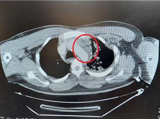 車禍外傷性胸主動脈剝離8成到院前離世 醫用1招續命