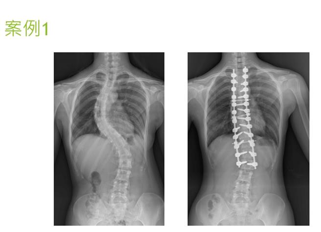 台中荣总创新利用AR扩增实境眼镜搭配术中导航技术进行脊椎侧弯矫正手术，病患严重的脊椎侧弯，术后角度趋近正常。（台中荣总提供／冯惠宜台中传真）