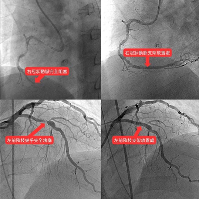 黃維健表示，該位病患的右冠狀動脈100％完全阻塞，左前降枝已有90％狹窄（左），經評估決定兩條動脈皆須打通，各置放1支塗藥支架（右）。手術後，病人血壓迅速回升，生命徵象也立即回穩。（新竹馬偕醫院提供／陳育賢新竹傳真）