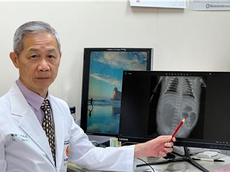 胎兒腸道閉鎖又穿孔 緊急剖腹跨科醫療團隊搶救 母子均安