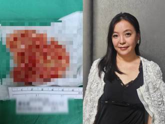 背长6公分瘤「如绞肉」急动刀！女星揭术台上吓到瘫软过程