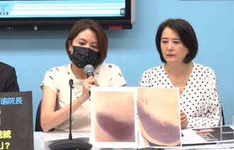 影》陈菁徽臀部「超大片瘀青」照曝光 泪洒记者会