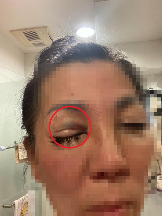 徐女驗傷單以及其臉被遭毆有瘀傷、右眼瘀青腫漲的照。（江和樹提供／馮惠宜台中傳真）