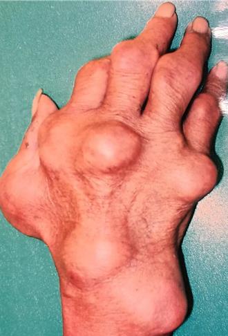 「王者之病」年輕化 醫提飲食原則避痛風找上身