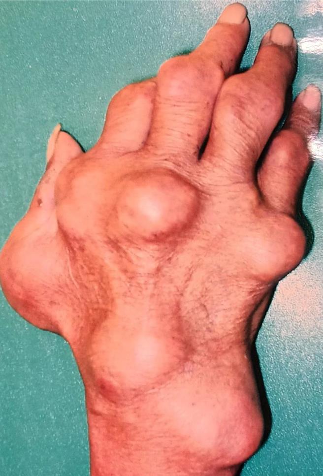 因痛風發作，手脚關節發炎腫痛，並長出許多不痛的結節。（中正脊椎骨科醫院提供／楊舒婷高雄傳真）
