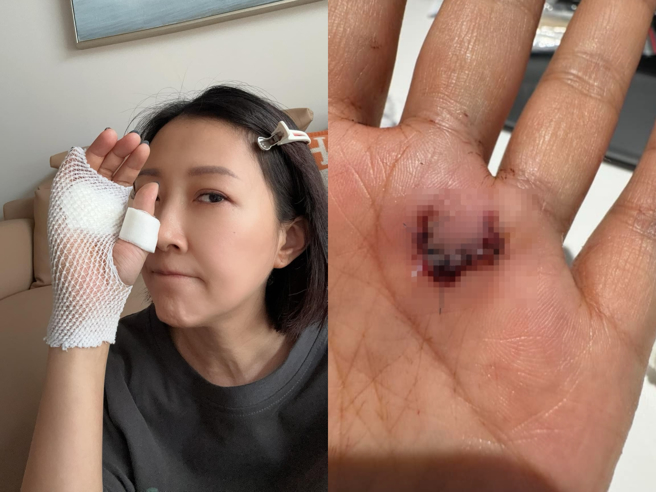 余皓然受傷縫針，傷口形狀成急診室焦點。（圖／翻攝王中平和余皓然愛的小屋   臉書）