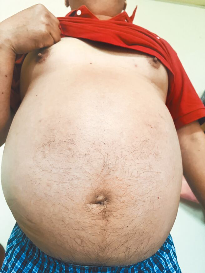 彰化1名48歲黃姓男子因心臟問題，身體內的水分無法排出，肚子腫得像懷了3胞胎，黃男曾因腹脹難耐，到某醫院1天內打31針利尿劑，排出1萬cc的尿。（員榮醫院提供／葉靜美彰化傳真）