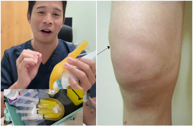 全民跟風模仿ENERGY的16蹲，復健科醫生侯鐘堡提醒民眾小心引起「關節炎」，嚴重者可能要抽膝蓋積水。（圖／摘自FB侯鐘堡醫師）