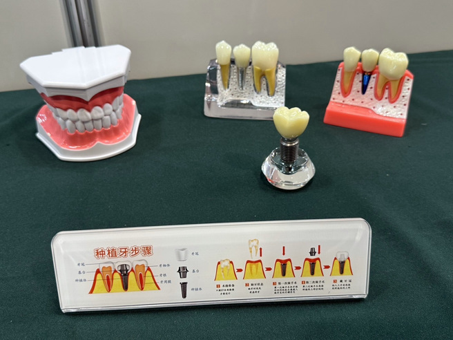 以微弧氧化法在钛牙科植体表面披覆锶钙磷化合物，具备增加植体抑菌效果。（照片/龙华科大提供）