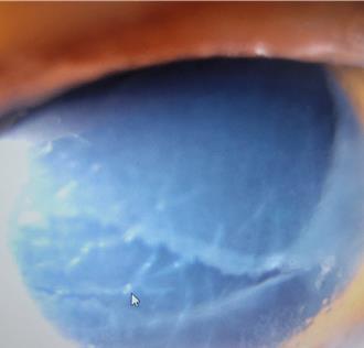 獨》女大生戴蛙鏡游泳 摘下後眼球破大洞