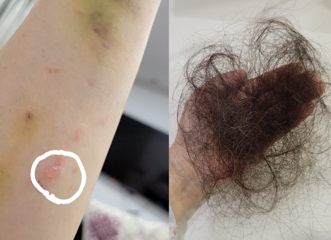 她还提到，化疗后自己皮肤变得敏感脆弱，掉髮也相当严重。（图／翻摄自作家小彤脸书）