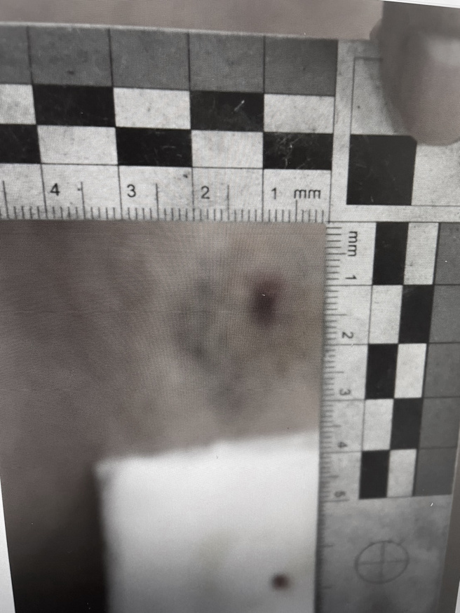 女子腿部疑似遭BB彈射擊、瘀青。( 葉庭欣/翻攝 )