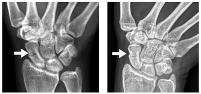 李育成医师说明，案例彭小姐在经由近两个月治疗后，可由X光看出骨头有明显的癒合。（新竹台大分院提供／邱立雅竹县传真）