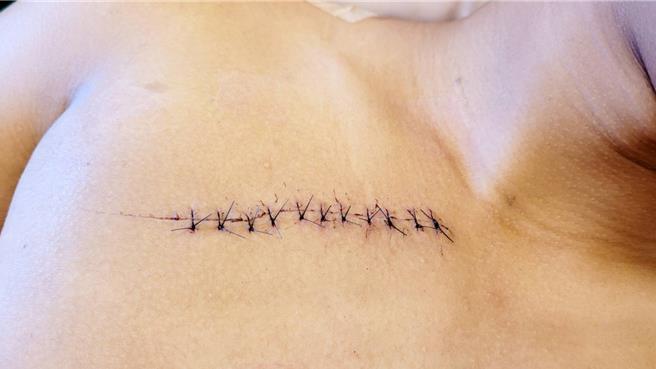 吕父秀出儿子肩、胸、上臂伤口缝合后贴上美容胶后的情况，长长伤疤，让人不舍。（吕父提供）