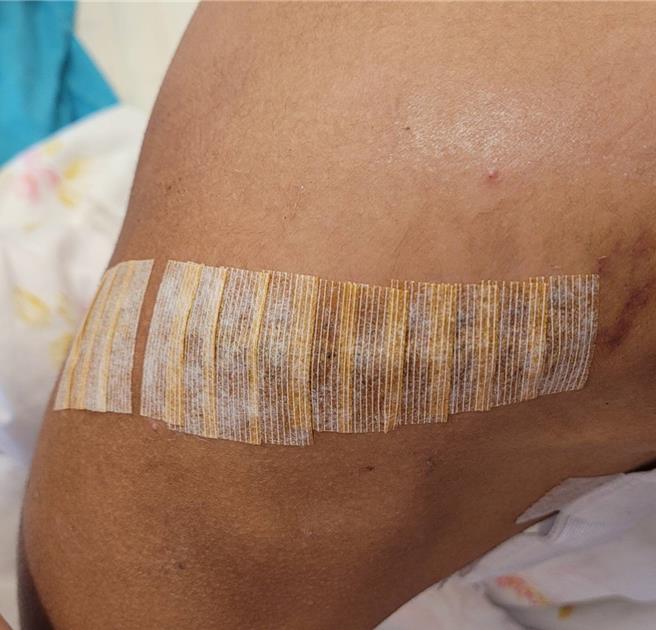 吕父秀出儿子肩、胸、上臂伤口缝合后贴上美容胶后的情况，长长伤疤，让人不舍。（吕父提供）