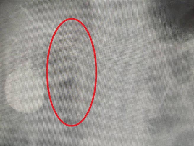 男子阻塞的胆管，经医师进行胆道支架置入术(红圈处)后，顺利改善黄疸问题。（大千医院提供／李京升苗栗传真）