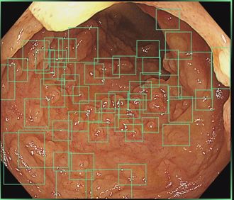慎入！醫曝「AI大腸鏡畫面」在場員工全尖叫