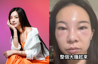 奎丁患蜂窩性組織炎險毀容 超驚悚過程曝光