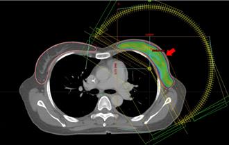 保住胸口爱的印记 医歼灭乳癌展开美丽图腾的守护战