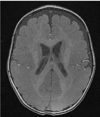 大腦沒皺褶！長庚、陽明交大找出「平腦症」致病基因