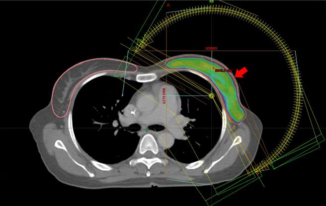 在为患者进行光子刀放射治疗时，特别利用电脑精准运算，将放射剂量调控在安全又有效的范围，完成25次的疗程后，不但没有破坏她的刺青，目前追踪检查也无癌细胞踪迹。 （箭头所指是患者接受放射治疗的左乳位置）（澄清医院提供／冯惠宜台中传真）