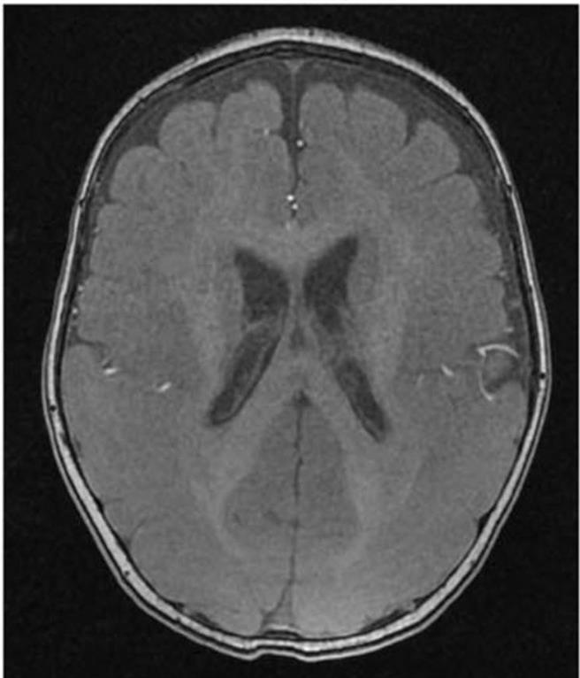 高雄長庚有病患大腦後面枕葉區為主的腦迴消失和增厚，臨床上診斷為罕見的平腦症，恐會嚴重影響發育。（高雄長庚提供／任義宇高雄傳真）