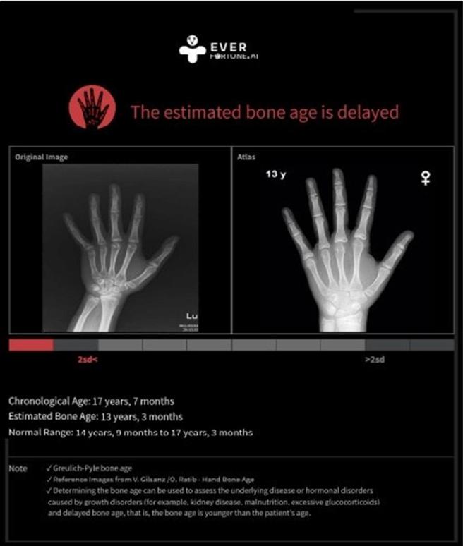 长佳智能骨龄辅助诊断系统，获美国FDA上市许可。图／业者提供