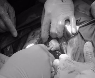 雙胞胎破水 台大醫見「寶寶伸手求援」感動畫面曝