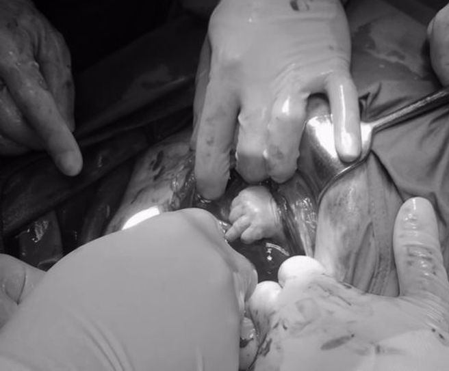 患有胎間輸血症候群的雙胞胎，其中羊水多的寶寶手伸出來求援。（翻攝自施景中FB）