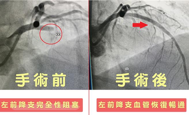 台中45岁洪先生不菸不酒，但爱吃烧肉、甜点致血脂、血糖偏高，日前因心肌梗塞昏厥送医，冠状动脉左前降支竟100％完全性阻塞，幸72分钟内完成检查及支架置放手术救回一命。（乌日林新医院提供／潘虹恩台中传真）
