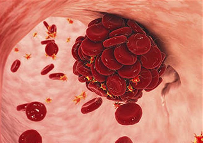 陸科學家發現治療免疫性血小板減少症突破性新療法。（新華社）