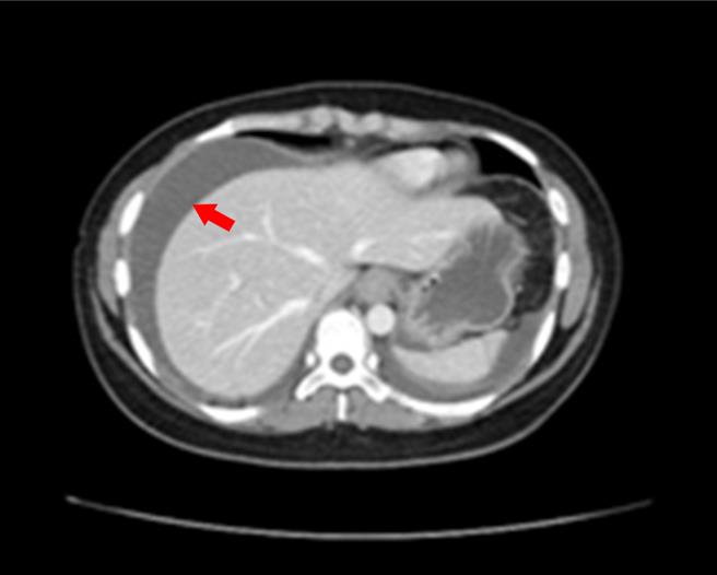 1位30岁女性因腹胀、腹痛、呕吐、腹泻挂急诊，经断层扫描检查发现患者有明显腹水。（澄清院提供／冯惠宜台中报导）