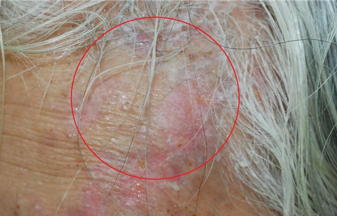 72岁王先生近期常感左侧头痛像「被雷击中」，日前额头开始冒出红疹及群聚型水泡，就医才发现为左侧三叉神经第一支的带状疱疹，幸经抗病毒药物加上止痛药、维他命B12等治疗顺利恢復。（仁爱长庚合作联盟医院提供／潘虹恩台中传真）