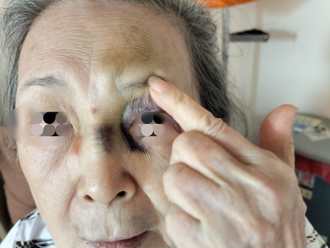 照顧新冠住院老公！80餘歲老太太「染疫摔倒一身傷」 變隔壁床病人